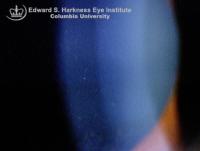 Slit lamp view demonstrates subtle grayish specks throughout the stroma.